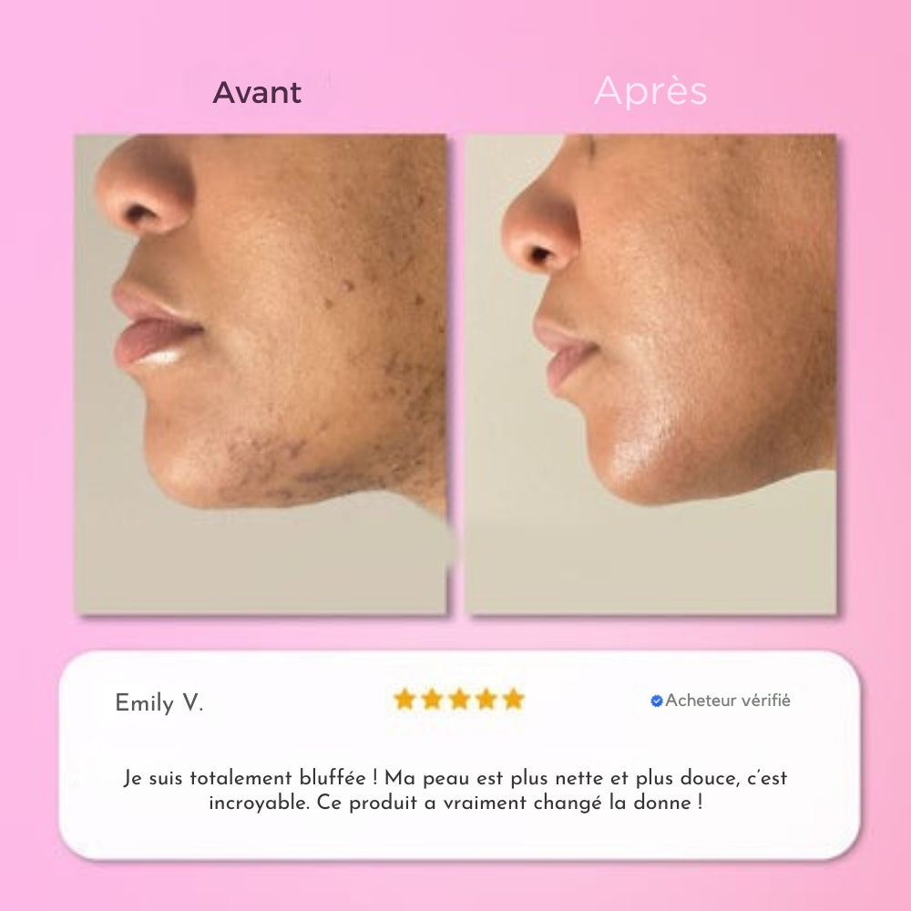 Soléa Épilation instantanée pour le visage et menton